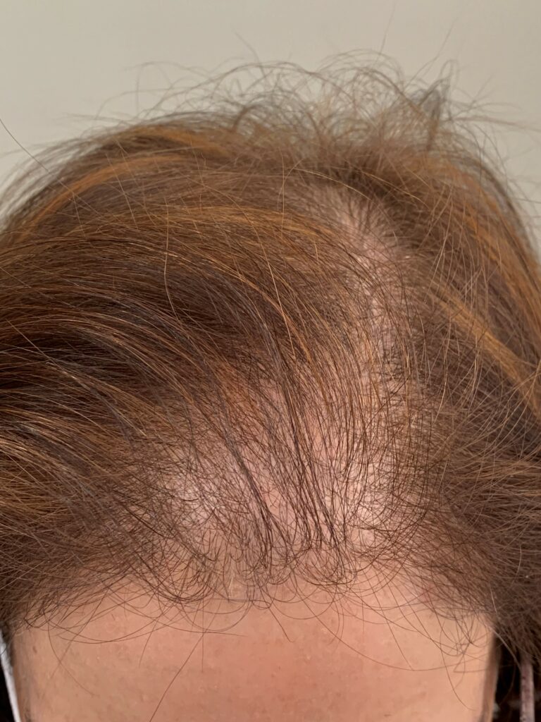 Alopecia androgenética femenina