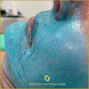 Blue Peel - Dermatología - Madrid