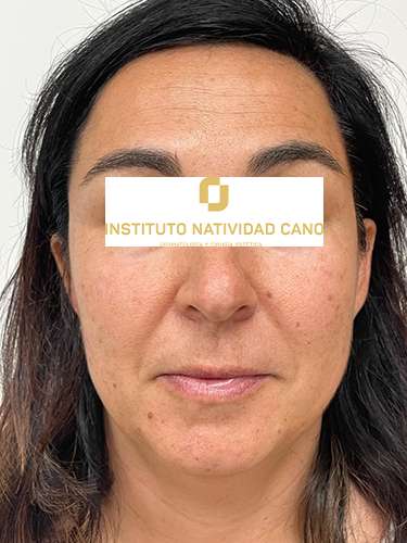 Láser CO2 - Instituto Natividad Cano - Dermatología Madrid