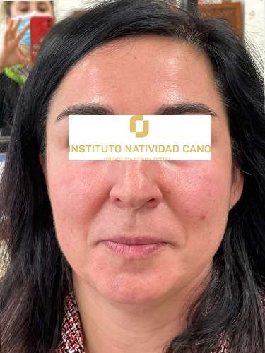 Láser CO2 - Instituto Natividad Cano - Dermatología Madrid