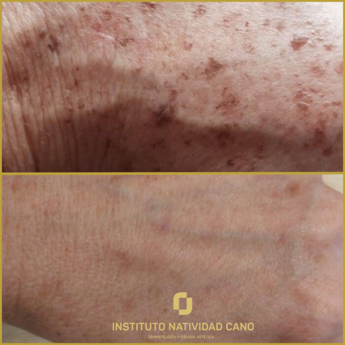 Láser IPL, luminosidad extra tras el verano para todo tipo de pieles