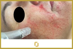 Microwhite, tratamiento facial de microneedling con ácido tranexámico