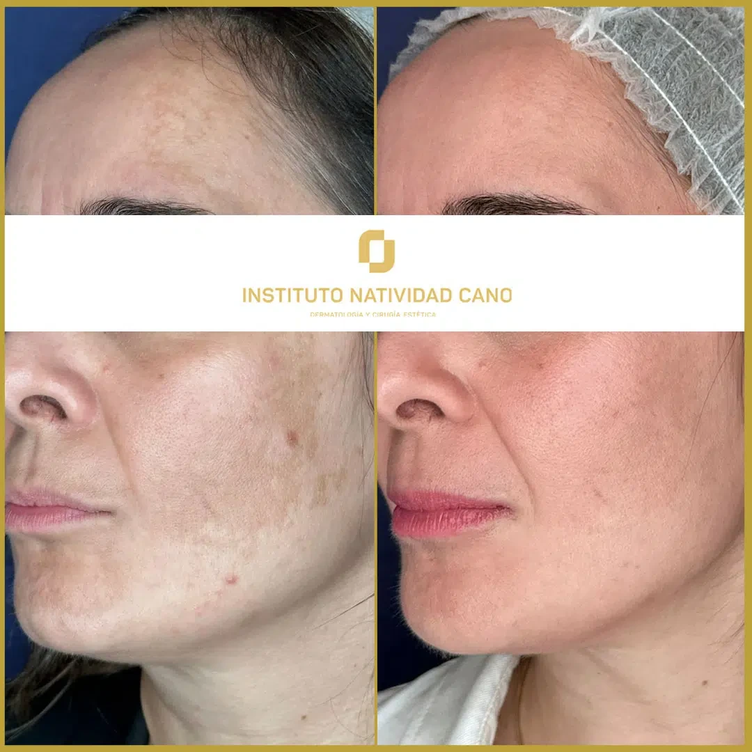 Tratamiento del melasma izquierda caso 3