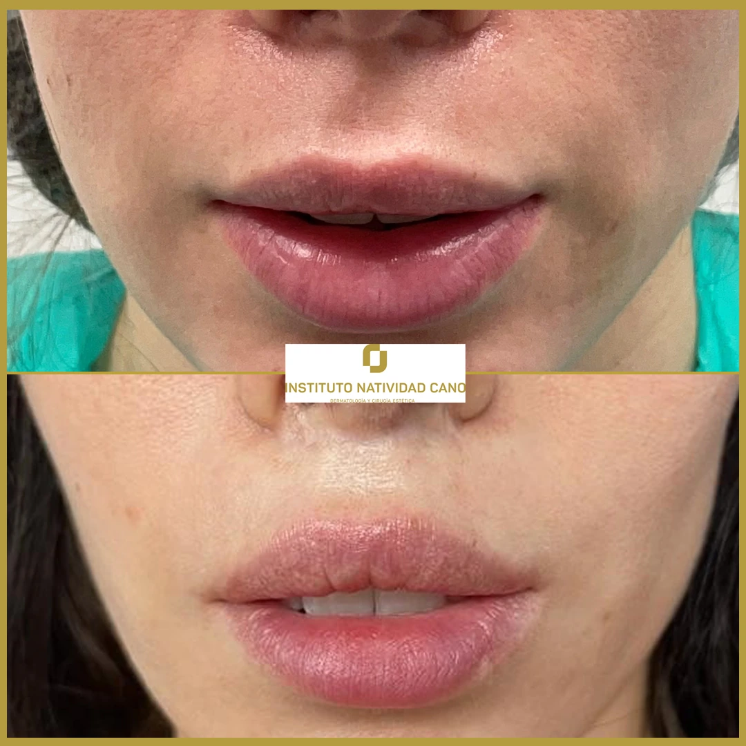 Lip-Lift