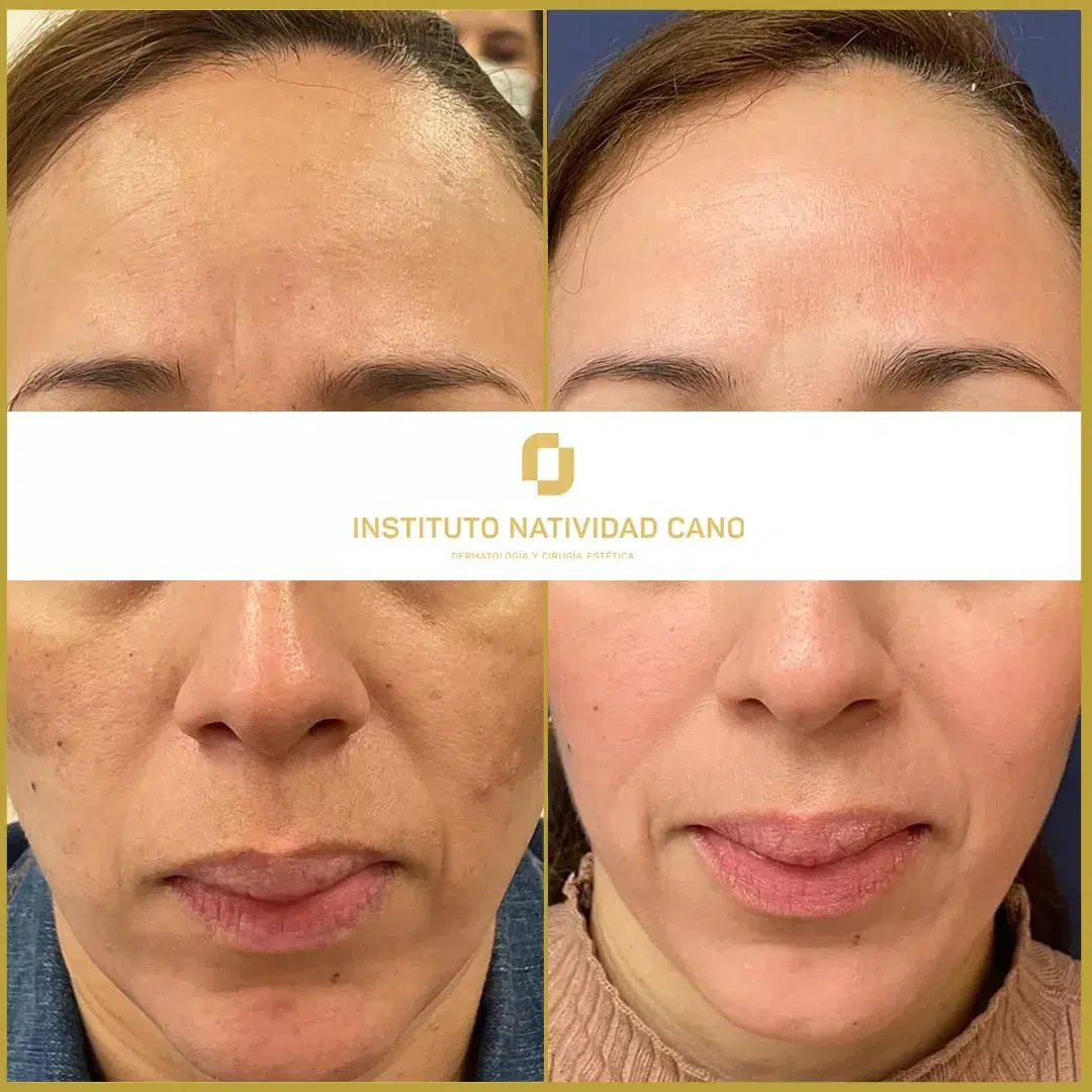 Tratamiento para el melasma - piel sana