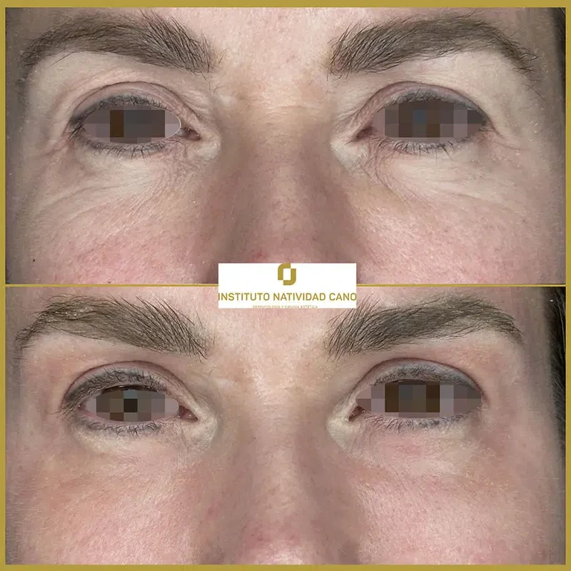 Tratamiento con Láser CO2: rejuvenecimiento facial y eliminación de imperfecciones cutáneas