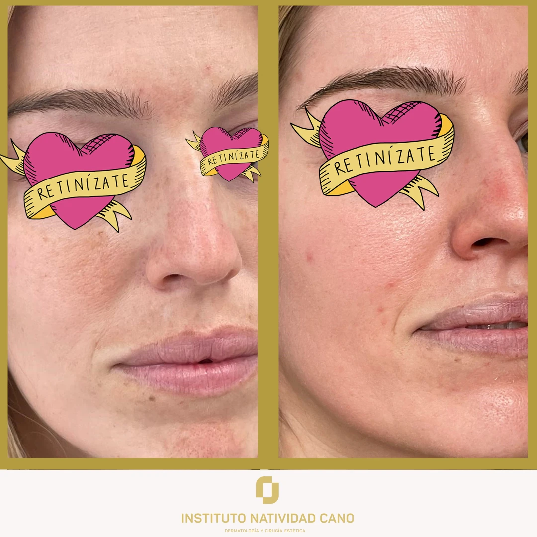 Melasma