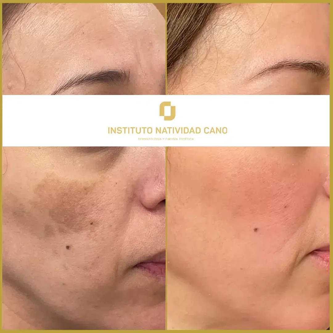 Tratamiento para el melasma - piel sana