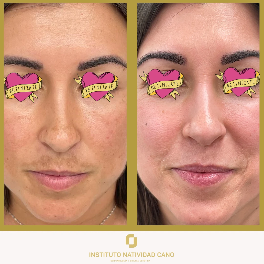 Melasma