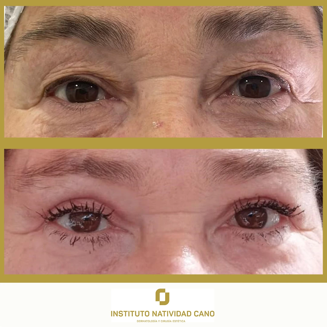 Blefaroplastia superior