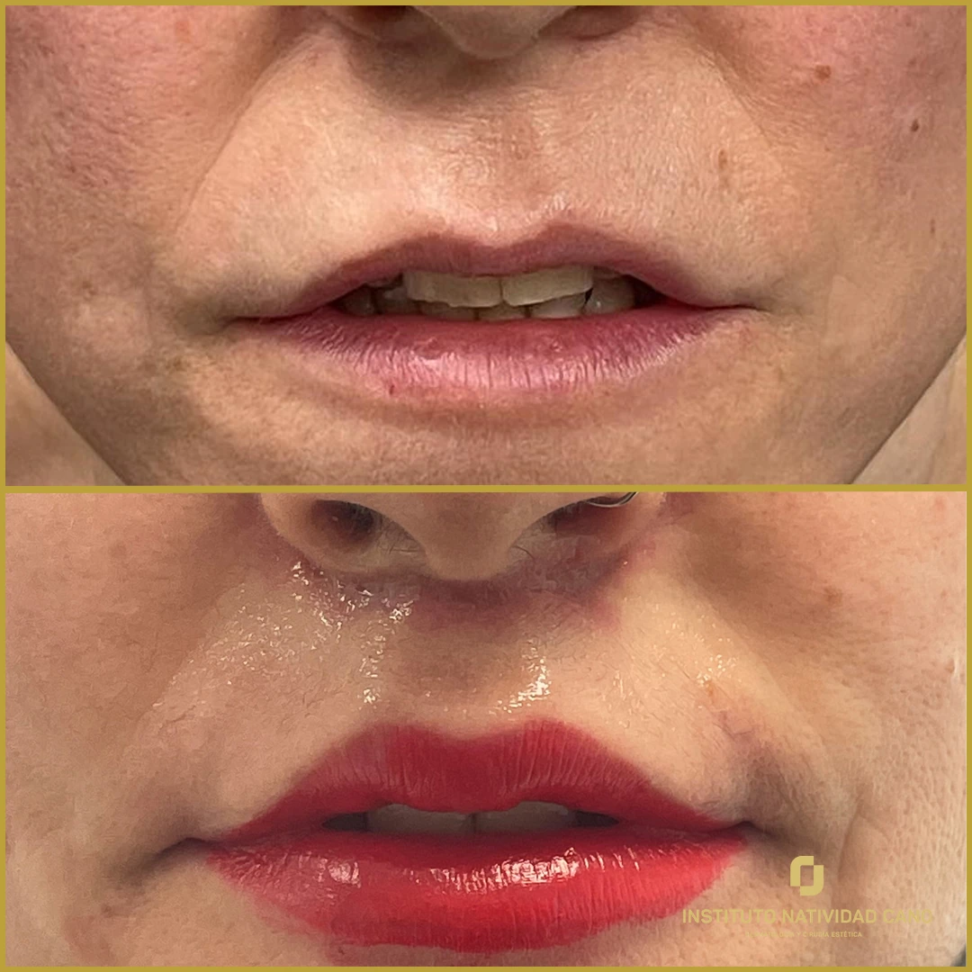 Lip Lift con avance de mucosa
