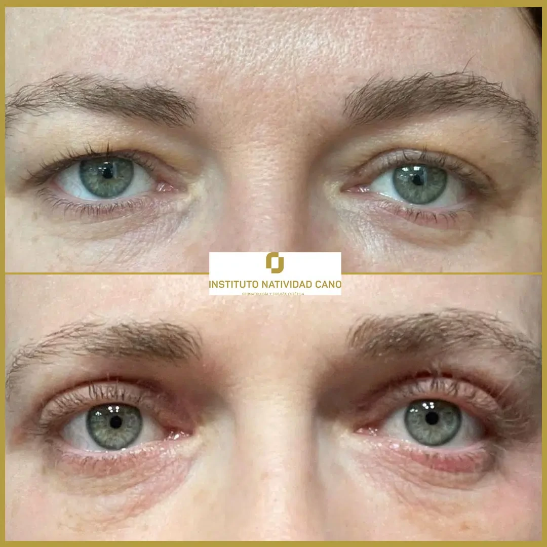 Tratamiento mirada-Blefaroplastia Caso 5-F