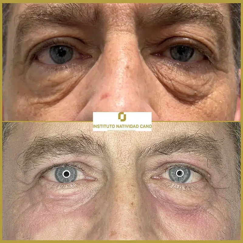 Tratamiento con Láser CO2: rejuvenecimiento facial y eliminación de imperfecciones cutáneas