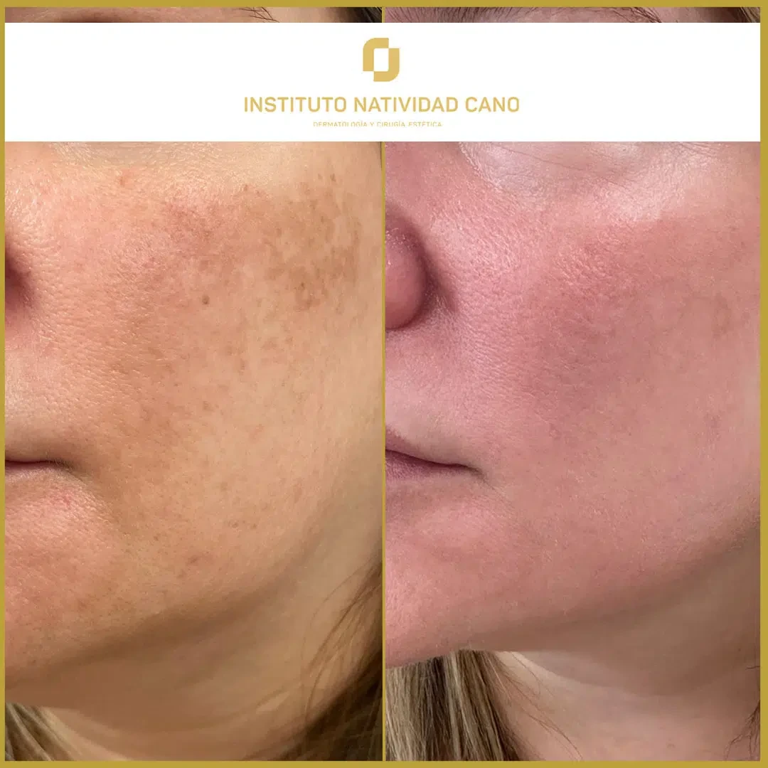 Tratamiento del melasma izquierda caso 2