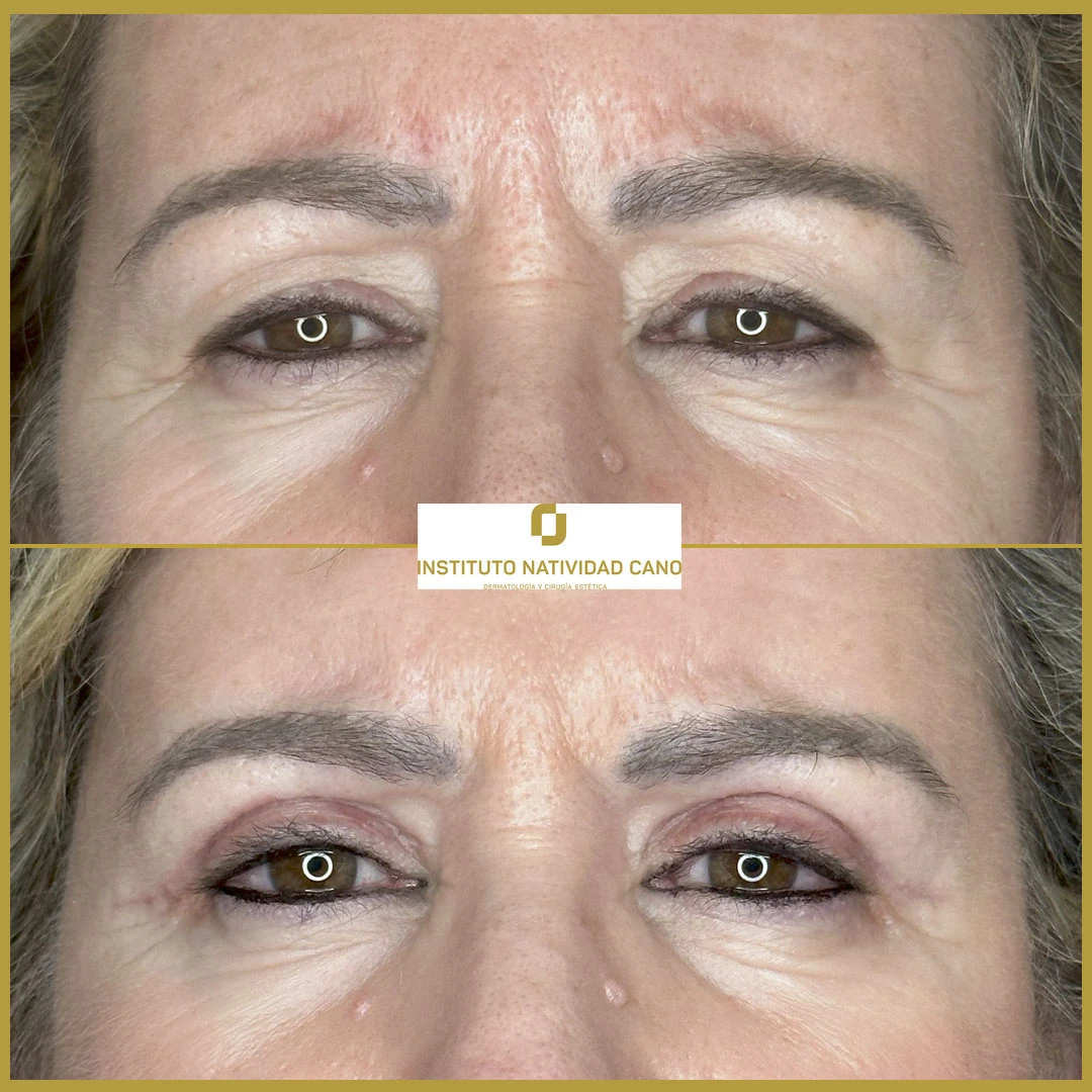 BLEFAROPLASTIA SUPERIOR Y LIFTING DE CEJAS-Caso 2-Frente