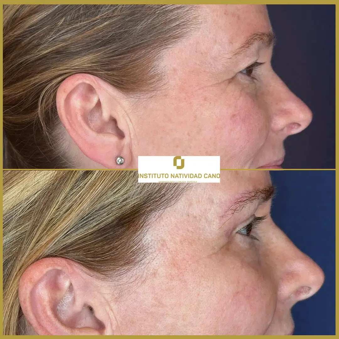 Tratamiento mirada-Blefaroplastia Caso 1-d2