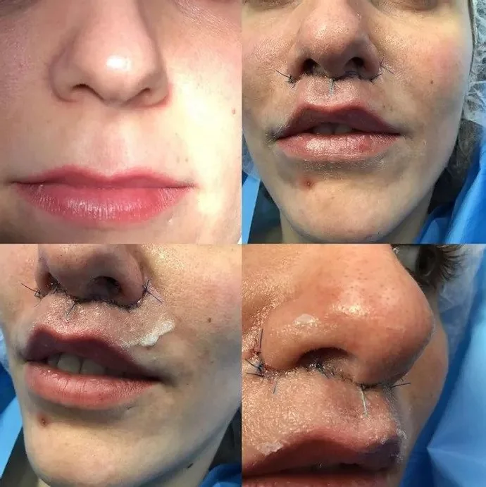 Lip Lift II: variedades de lip lift