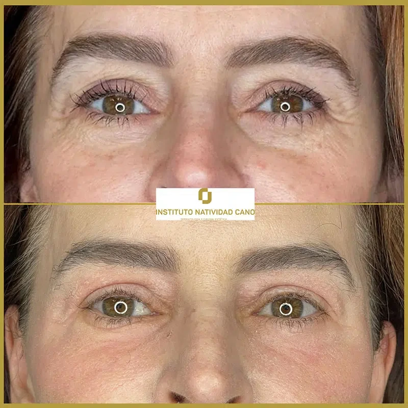 Tratamiento con Láser CO2: rejuvenecimiento facial y eliminación de imperfecciones cutáneas