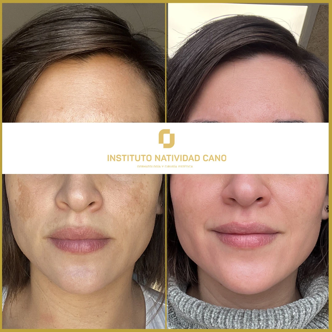 Tratamiento del melasma frente caso 5