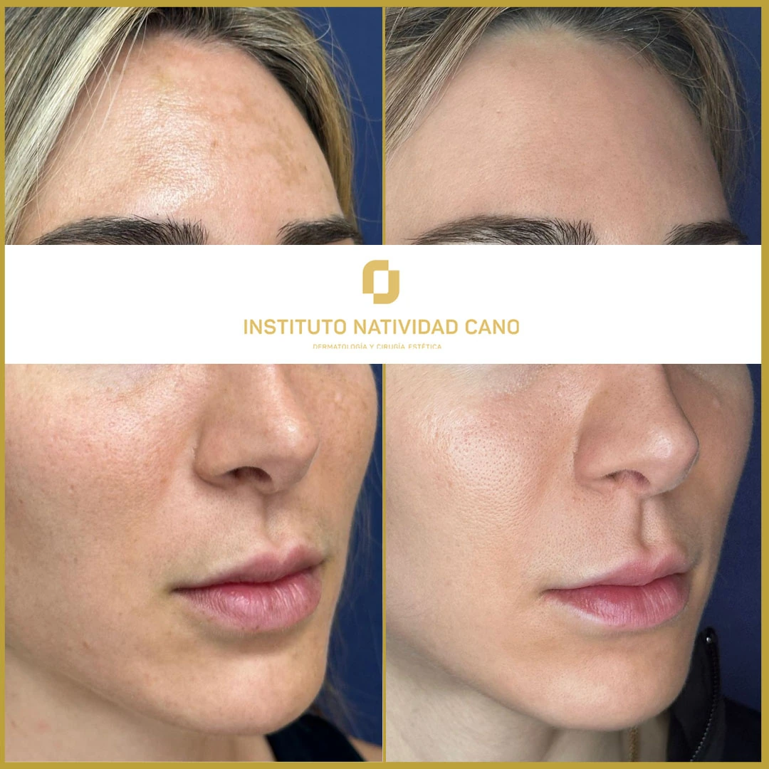 Tratamiento del melasma derecha caso 4