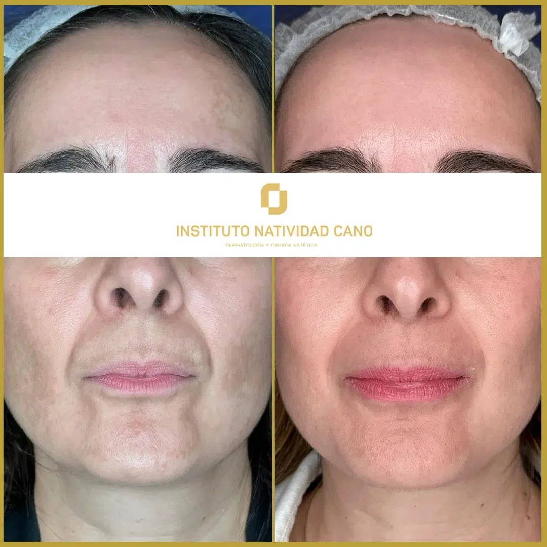 Tratamiento del melasma frente caso 3