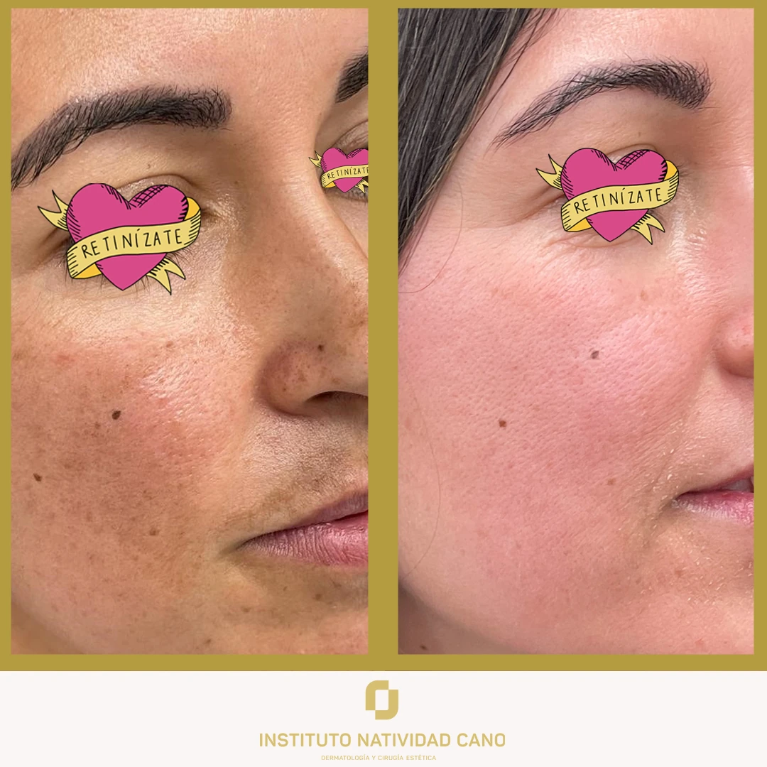 Melasma