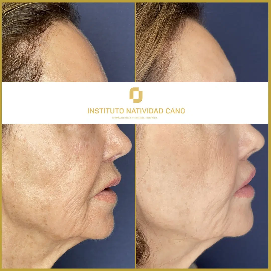 Lip Lift indirecto - Caso 2 - Perfil Derecha