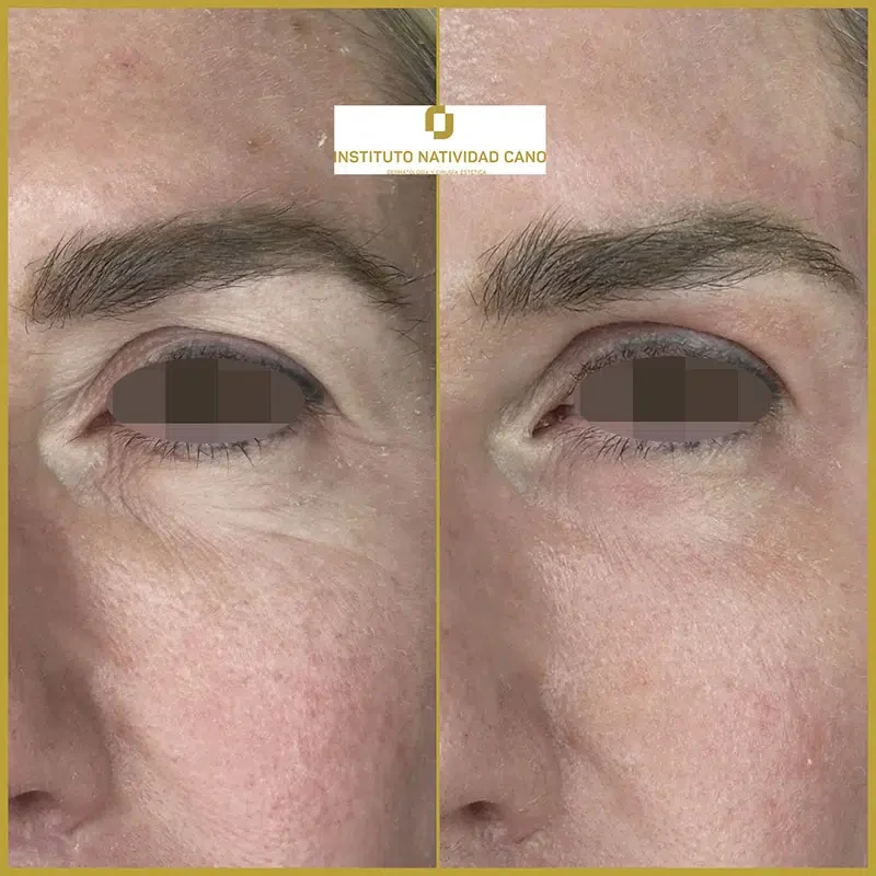 Tratamiento con Láser CO2: rejuvenecimiento facial y eliminación de imperfecciones cutáneas