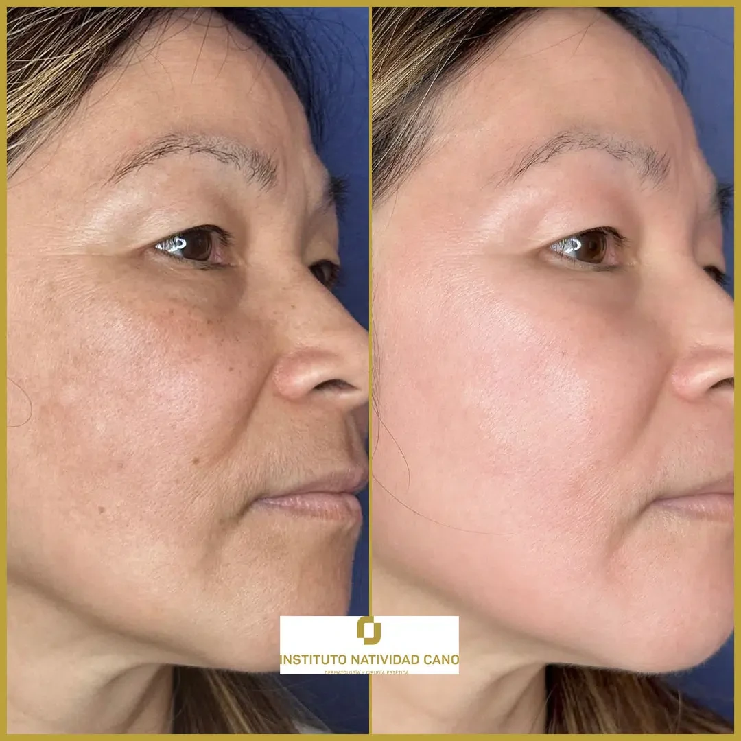 Tratamiento del melasma derecha caso 1