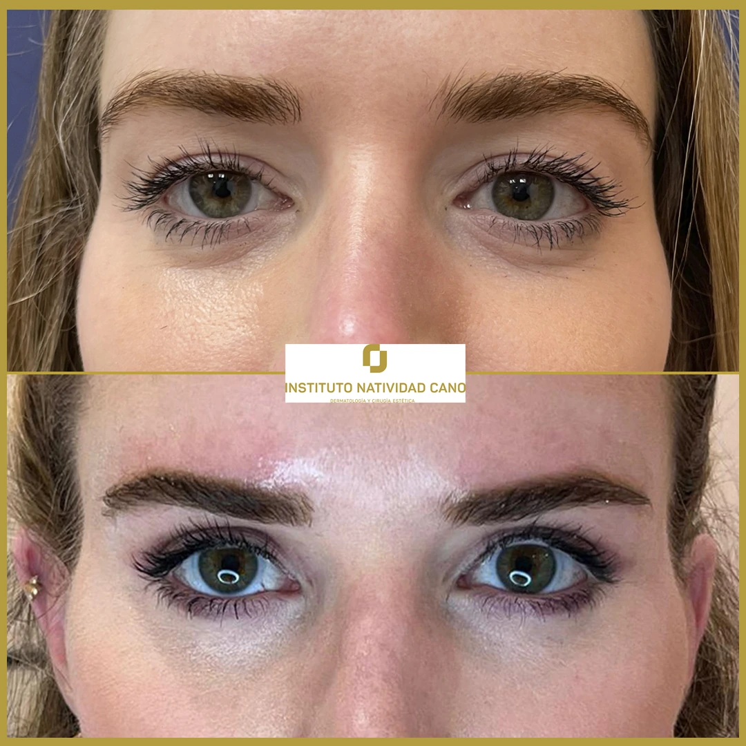 Blefaroplastia superior