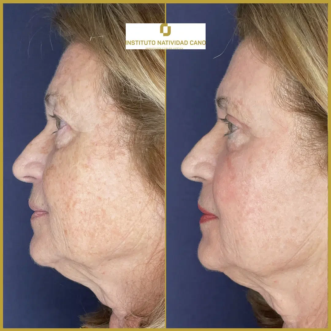 Tratamiento mirada-Blefaroplastia Caso 2-i