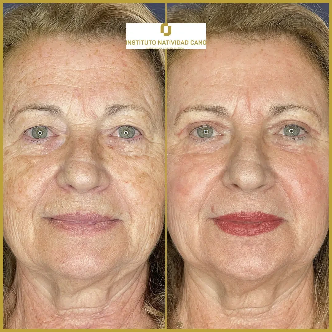 Tratamiento mirada-Blefaroplastia Caso 2-f