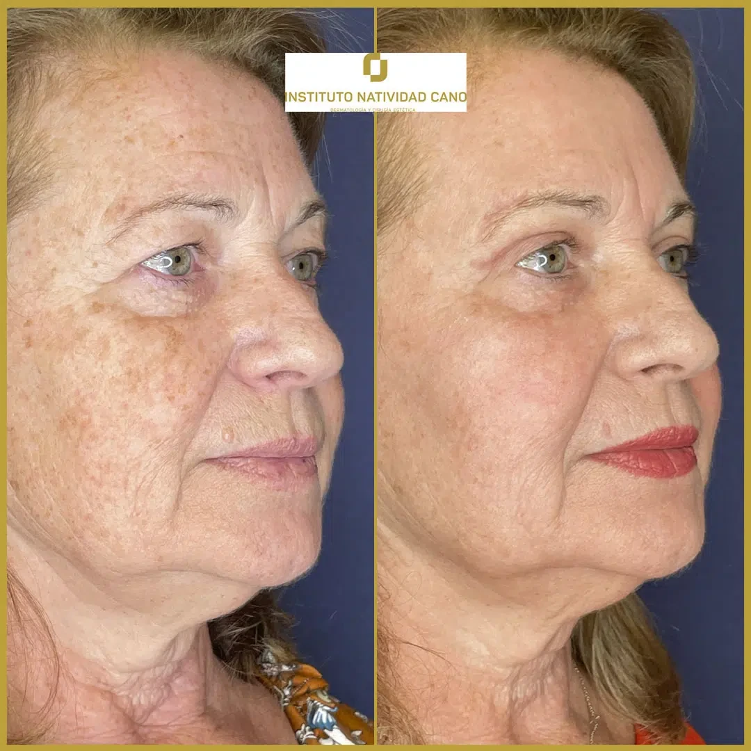 Tratamiento mirada-Blefaroplastia Caso 2-d