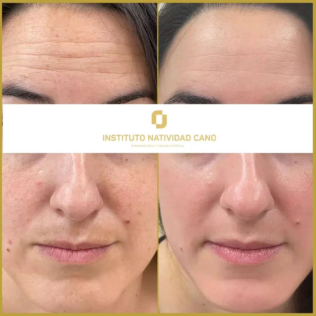 Tratamiento para el melasma - piel sana