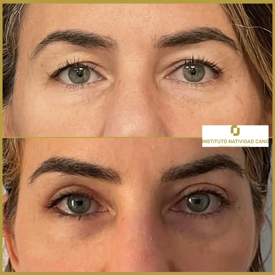 Tratamiento mirada-Blefaroplastia Caso 4-F