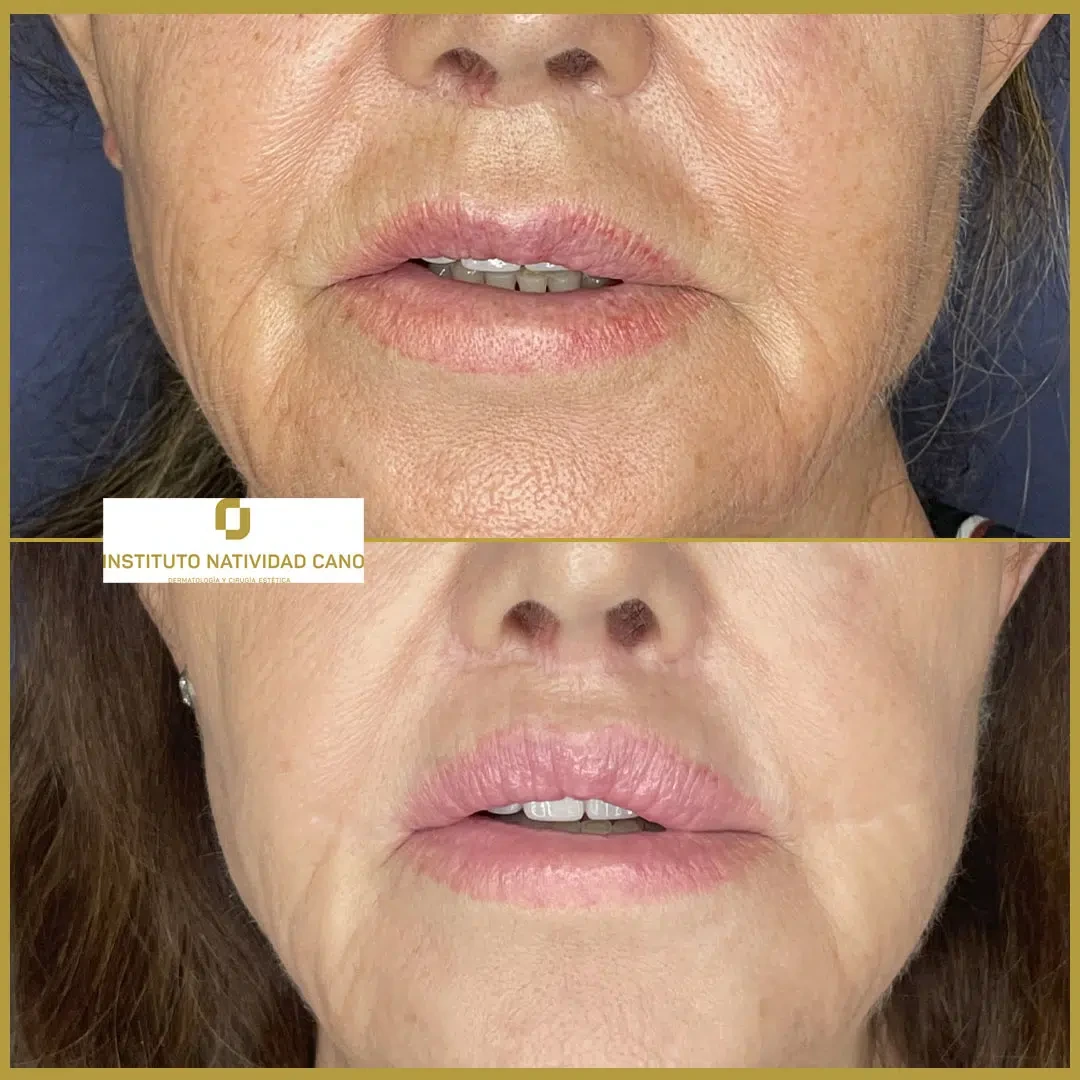 Lip Lift indirecto - Caso 1 - Frente