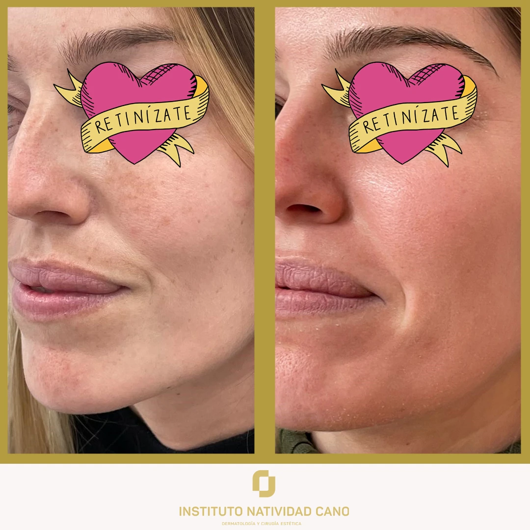 Melasma