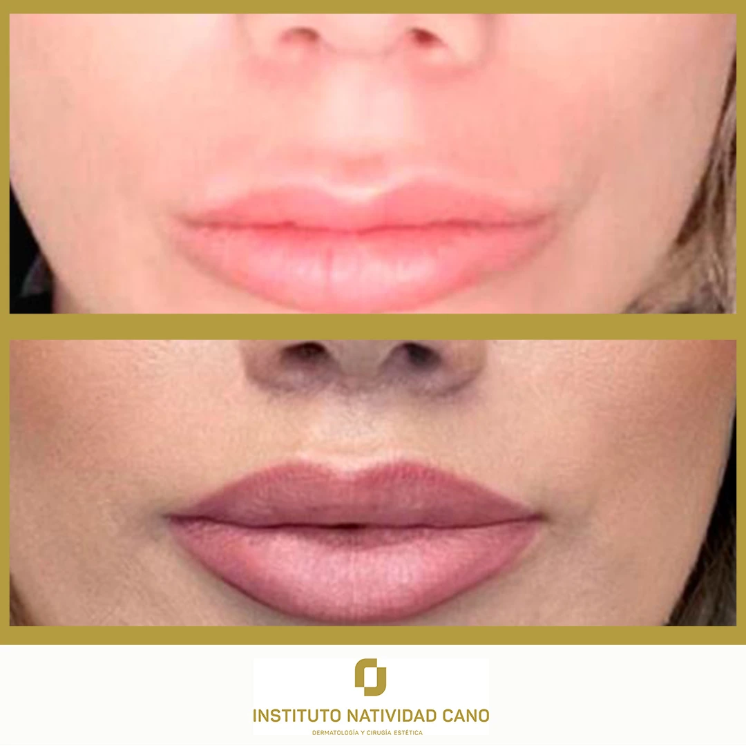 Lip Lift