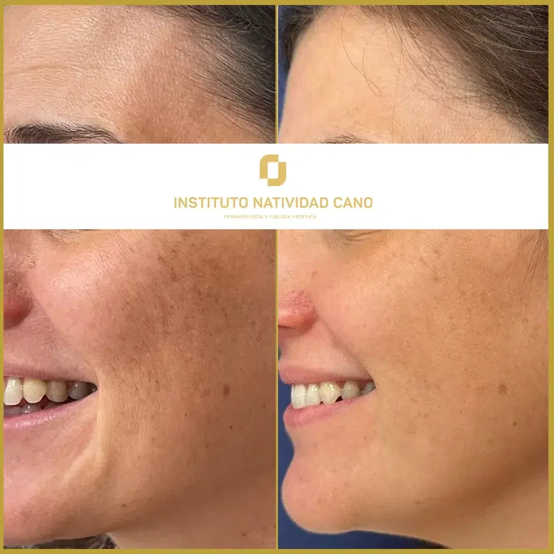 Tratamiento para el melasma - piel sana
