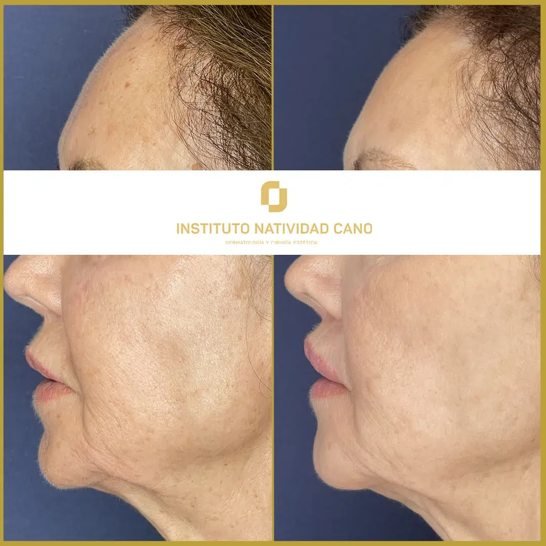 Lip Lift indirecto - Caso 2 - Perfil Izquierda