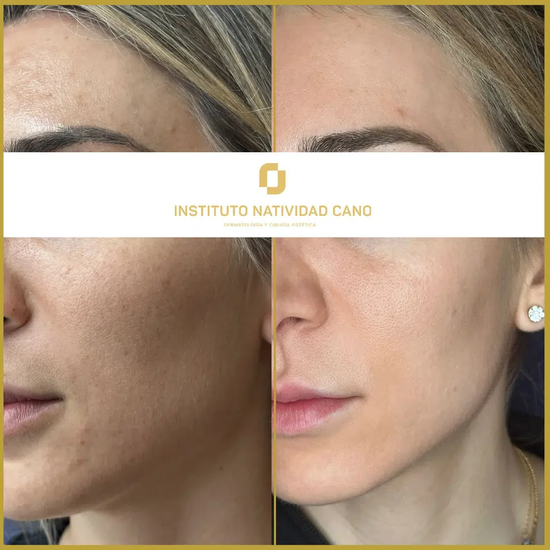 Tratamiento del melasma izquierdo caso 4