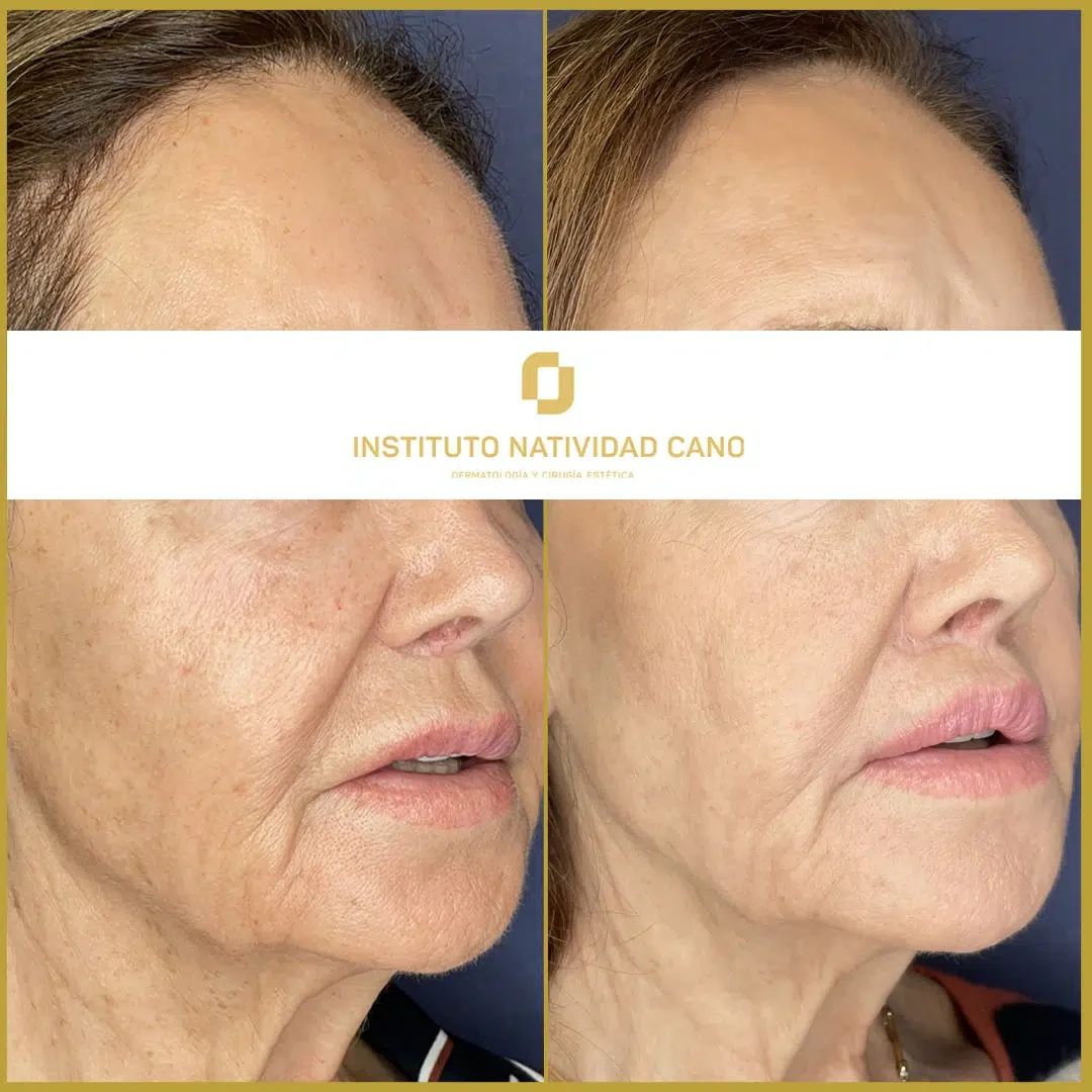 Lip Lift indirecto - Caso 2 - Derecha