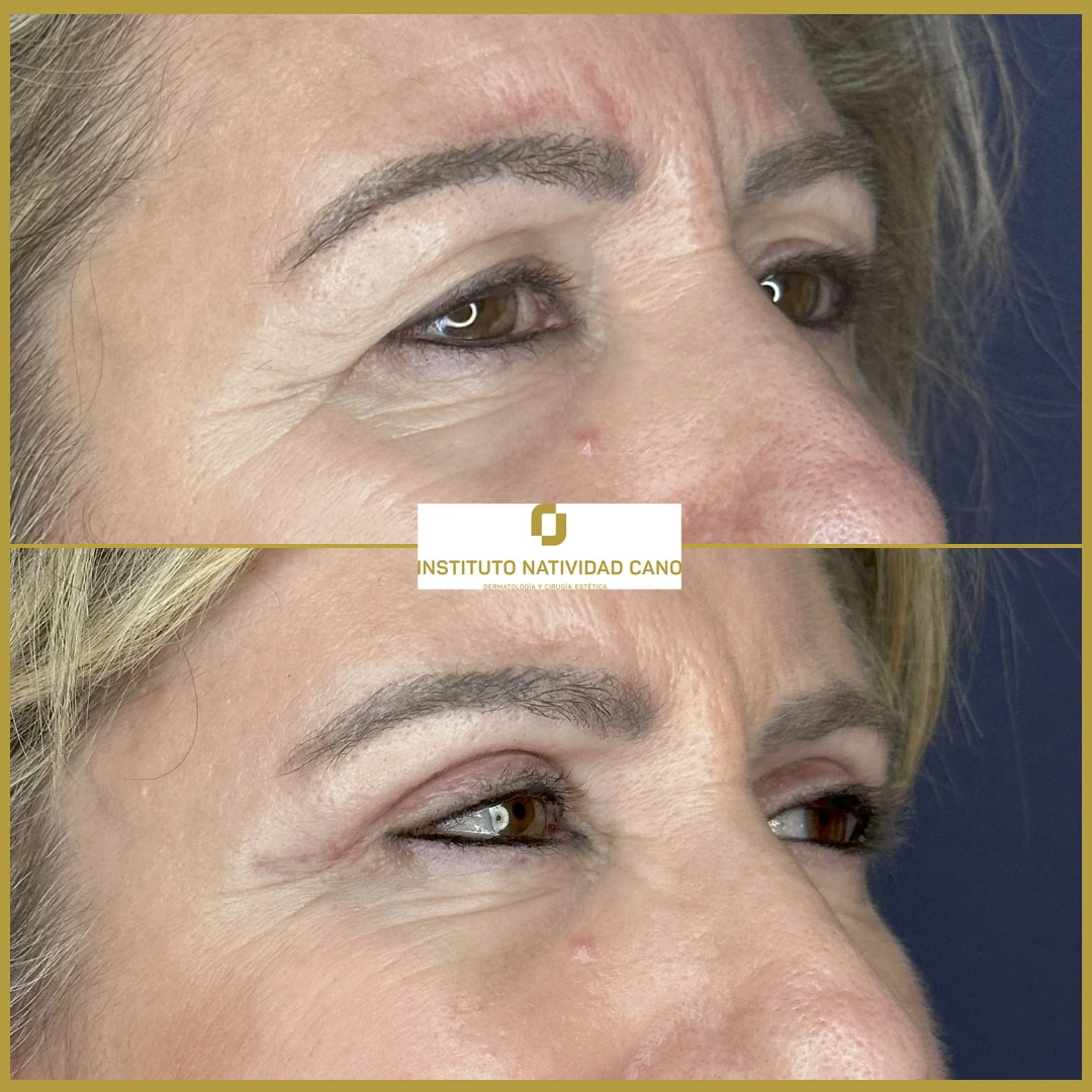BLEFAROPLASTIA SUPERIOR Y LIFTING DE CEJAS
