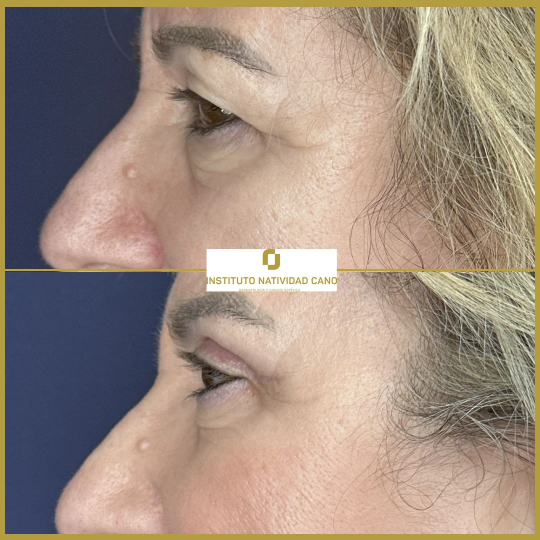 BLEFAROPLASTIA SUPERIOR Y LIFTING DE CEJAS-Caso 2-Izquierda perf