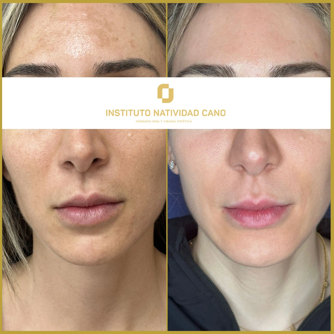 Tratamiento del melasma frente caso 4
