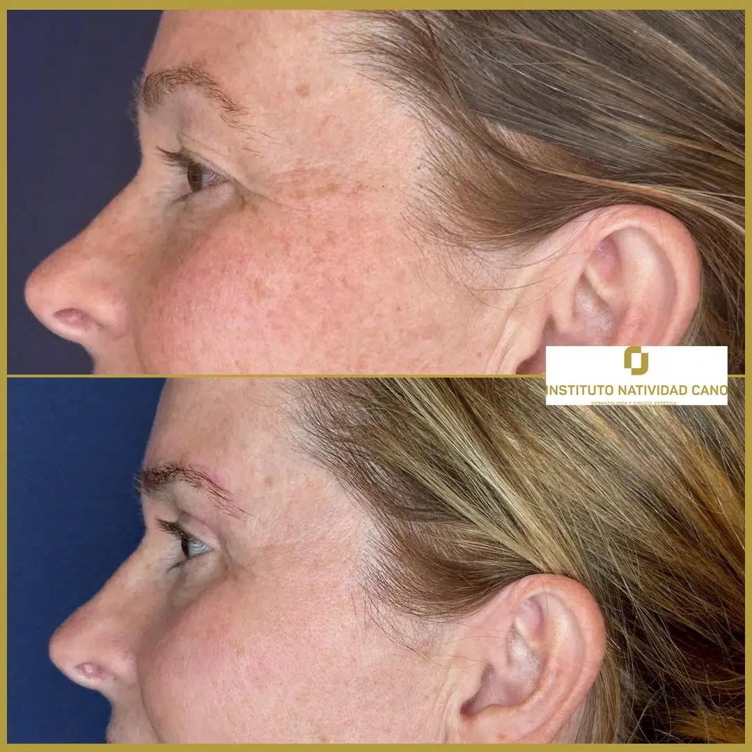 Tratamiento mirada-Blefaroplastia Caso 1-i2