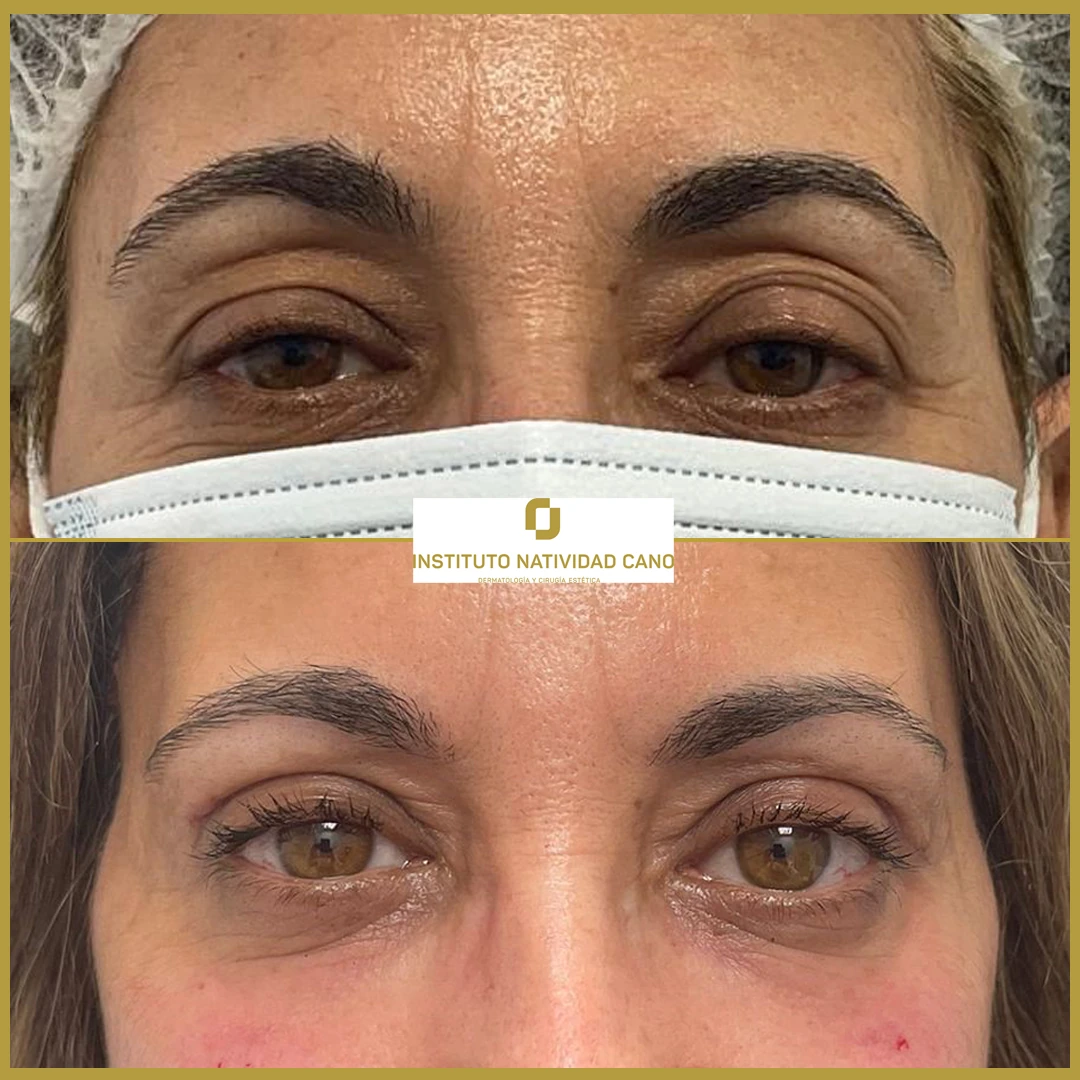 Blefaroplastia superior