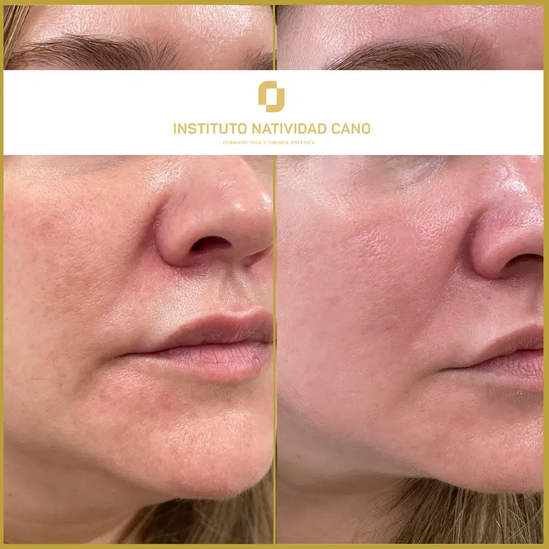 Tratamiento del melasma derecha caso 2