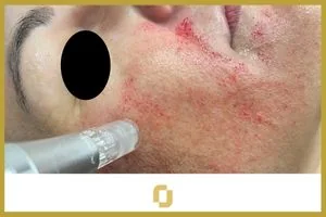 Microwhite, tratamiento contra el melasma