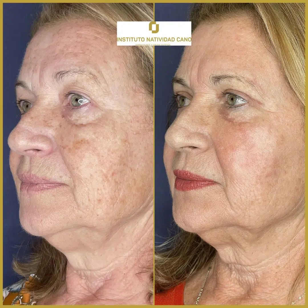Tratamiento mirada-Blefaroplastia Caso 2-i2